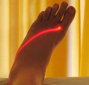 rawatan laser vena varikos pada kaki