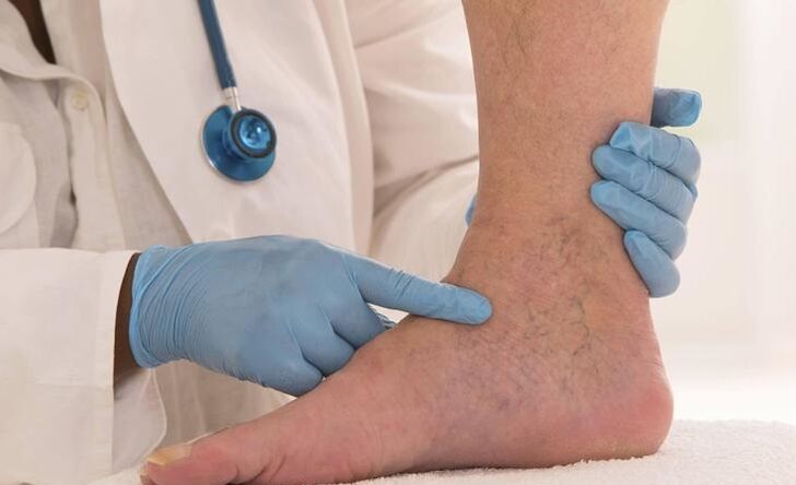 doktor memeriksa kaki dengan urat varikos
