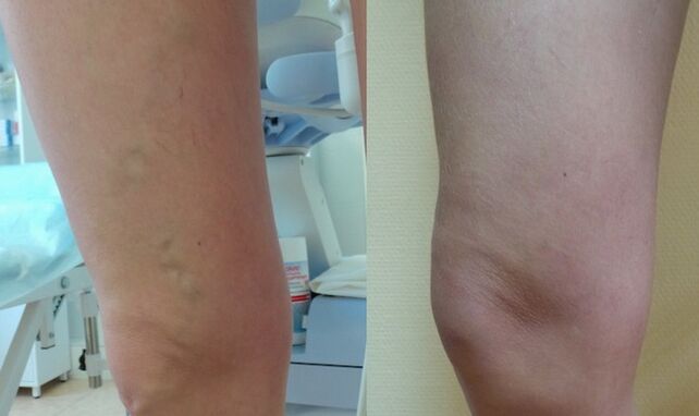 kaki sebelum dan selepas rawatan vena varikos retikular
