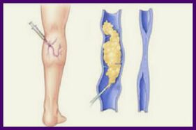 Sclerotherapy adalah kaedah popular untuk menghilangkan vena varikos pada kaki