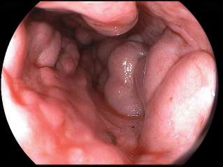 varises esofagus