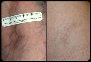 Sebelum dan selepas prosedur terapi laser